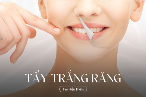 Tẩy trắng răng